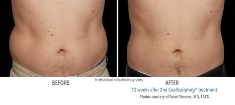 coolsculpting elite reviews.